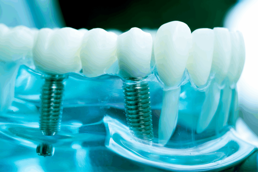 All on 4 dental implants Houston