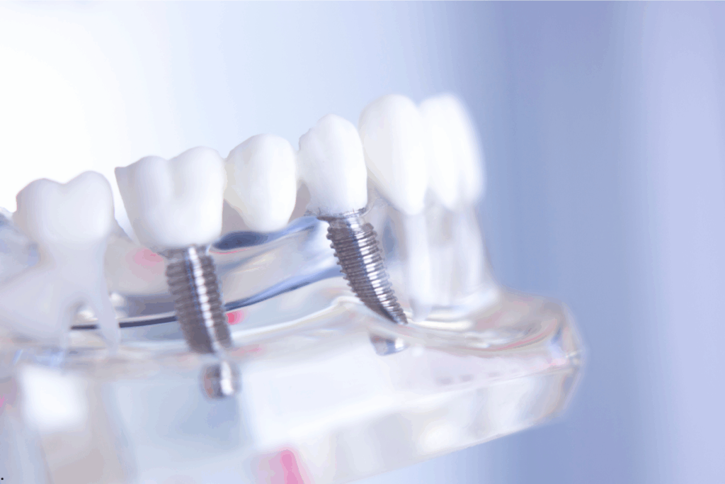 Snap-In Solution by All on 4 Implant