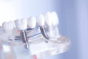 Snap-In Solution by All on 4 Implant