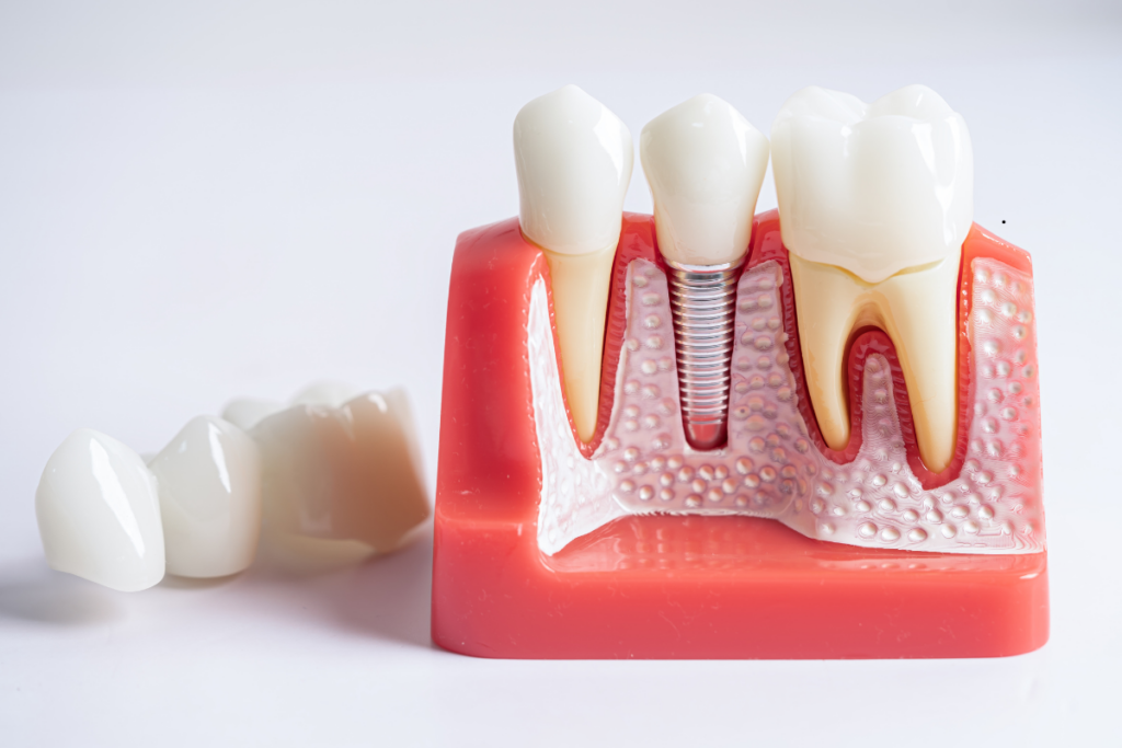 Dental implant Surgery Houston TX