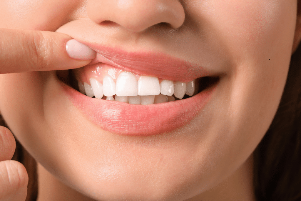Winter time Gum Recovery in Houston TX
